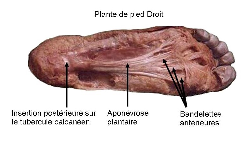 Semelle orthopédique pour épine clearance calcanéenne